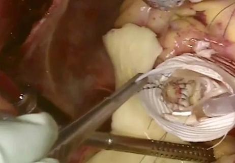 Valve-Sparing LGS Reimplantation Operation for Aortic Root Aneurysm Repair (Video)