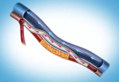 illustration of femoropopliteal bypass with the DETOUR system