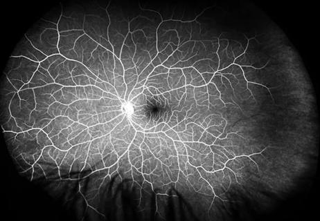 20-HRT-056-retinal-artery-occlusion-650&#215;450