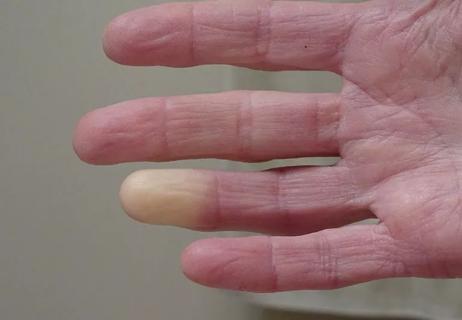 Raynauds syndrome in hand