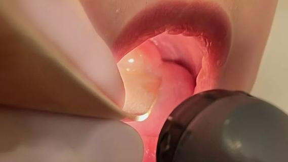 Pediatric uvular cyst