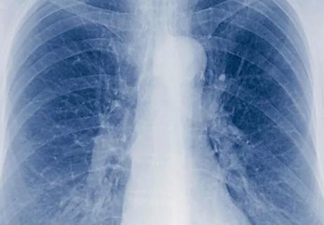 21-HVI-2228884_non-small-cell-lung-cancer_650x450
