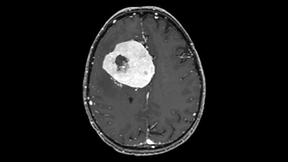 Large meningiolma