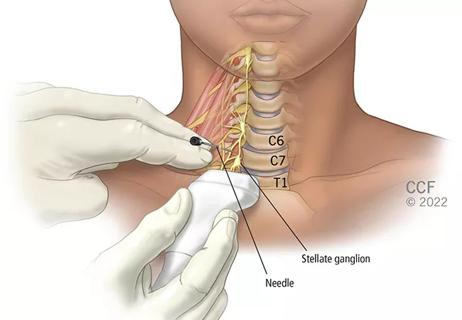 Stellate Ganglion Block