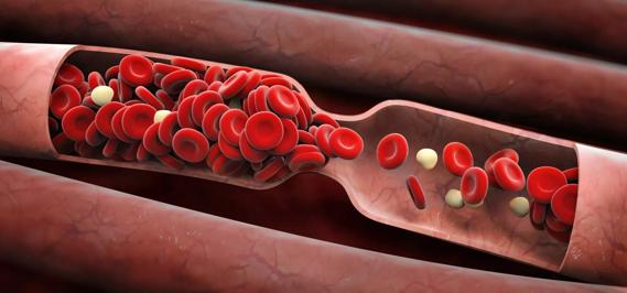 blood-clot_650x450 &#8211; Copy