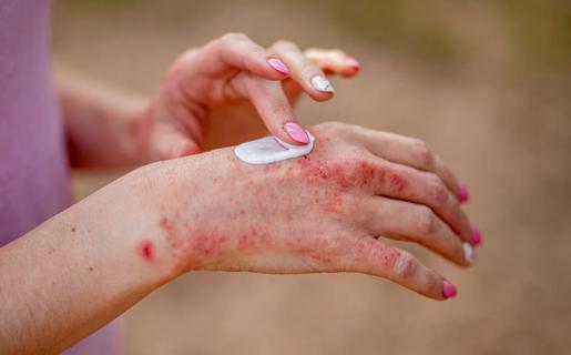 Person applying lotion to eczema rash on hands