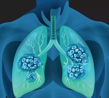 What Are the Chances a Lung Nodule or Spot Is Cancer?