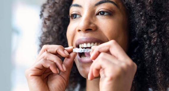 Adult inserting clear dental aligner tray into mouth