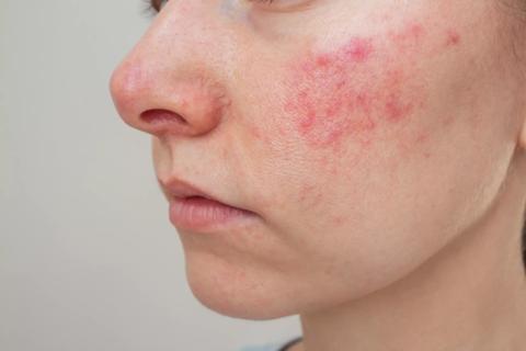 Close up of face with rosacea on cheeks