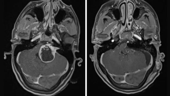 Vestibular Schwannoma pre- and post-operative CT scans