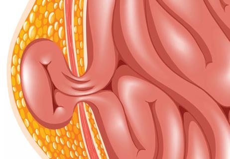 Hernia