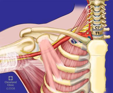 thoracic outlet syndrome illustration