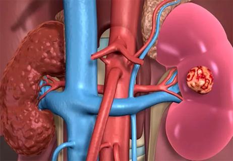 650&#215;450-Open-Partial-Nephrectomy