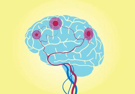Pain receptors in brain connecting to fibromyalgia