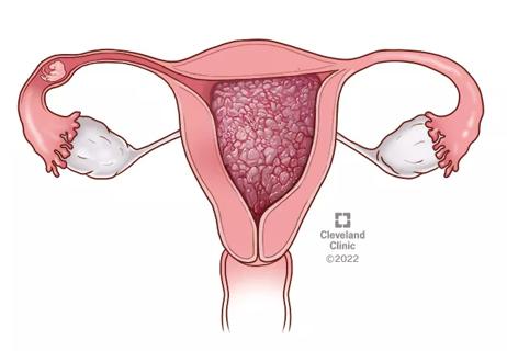 Ectopic pregnancy
