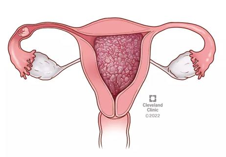 molar pregnancy