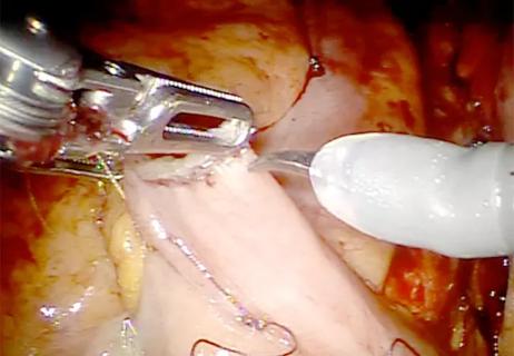 650&#215;450-Robotic Cystectomy