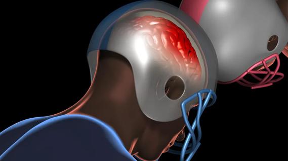 illustration of two football helmets butting into each other with an inflamed brain underneath one helmet