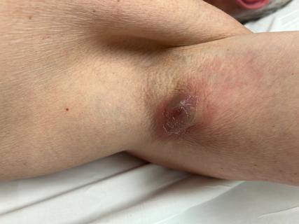 An open wound in a patient's armpit