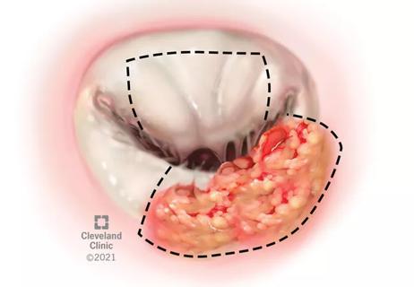 21-RHE-2059686-Littlejohn_Lupus-W-Libman-Sacks-EndocarditisAndAPS-CQD_650x450