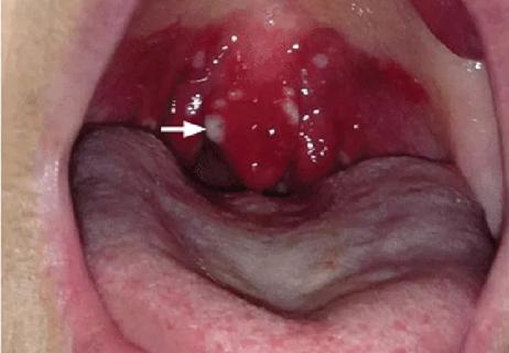 shomali_uvulitisandepiglottitis_f1