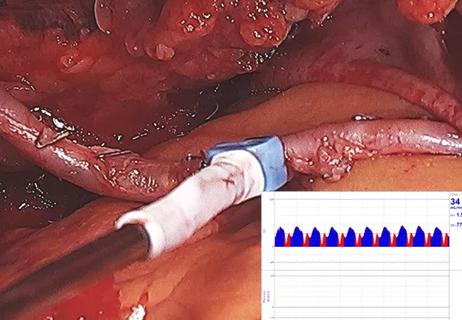 Intraoperative photo showing assessment of a CABG graft with a transit time flow meter