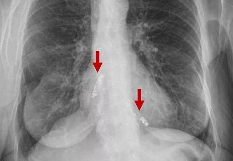 imaging study showing two leadless pacemakers in upper and lower chambers of heart