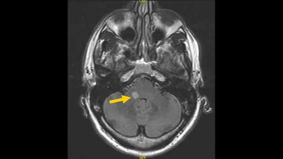 MRI image of skull