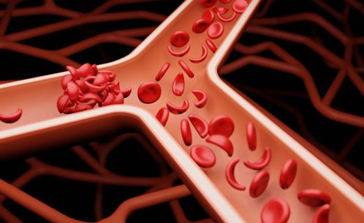 Anatomy of sickle cell blood clot