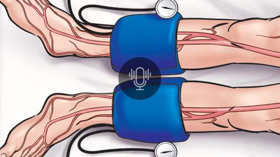 illustration of two pressure cuffs at a person's ankles