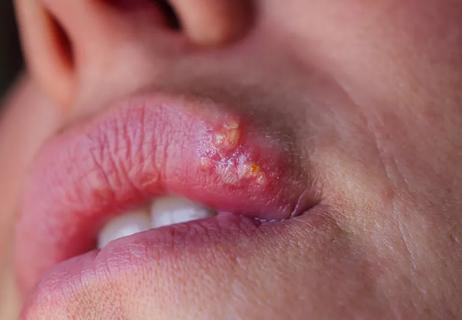 Closeup of a cold sore on a person's upper lip.