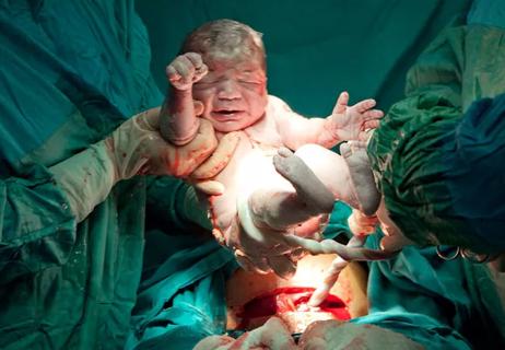 baby delivered via cesarean section