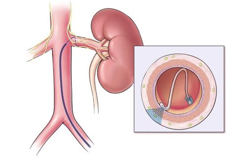 Illustration depicts renal denervation