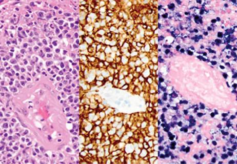 EBV-Associated Lymphoma