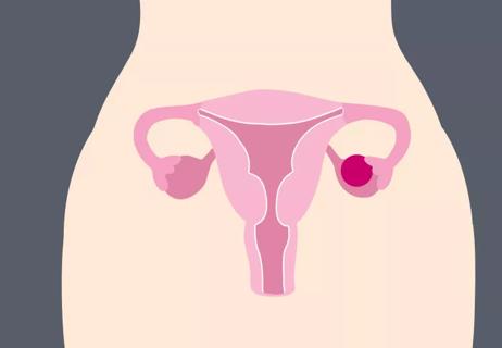 Illustration of an ovarian cyst before bursting