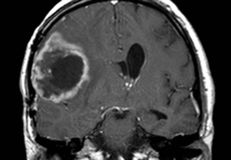 brain scan showing glioblastoma