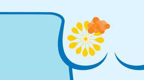 Illustration of breast cancer cells in a breast