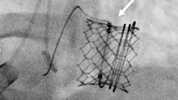 scan of an implanted stented heart valve