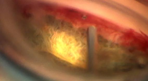 advances in glaucoma surgery