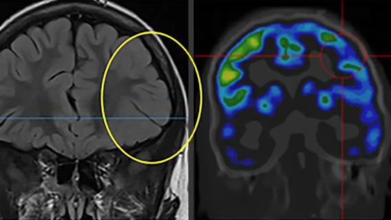 two brain scans side by side with a yellow circle on the left scan