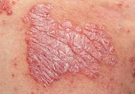 21-RHE-2356408-Hero-Image psoriasis