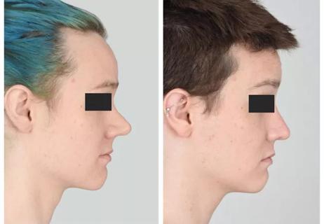 Facial feminization surgery techniques for transgender women