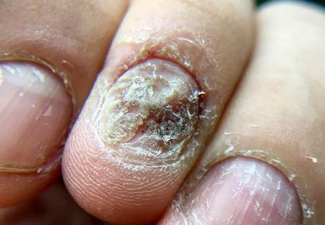 Fingernails discolored and damaged by psoriasis