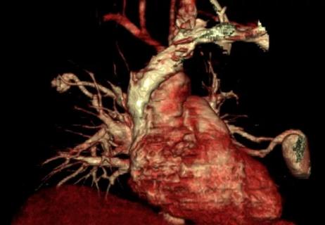 Digital reconstruction pulmonary angiogram demonstrating the two AVMs with their associated feeding vessels.
