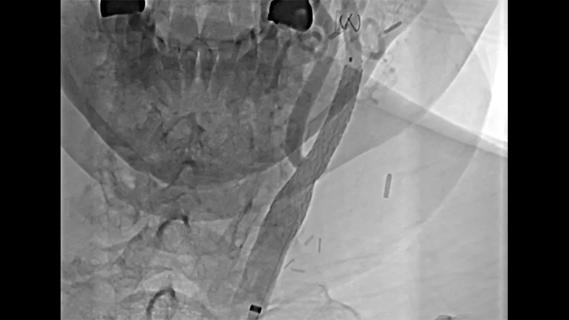 mesh stent in a carotid artery