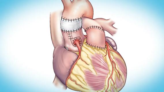 illustrated human heart with several sutured parts