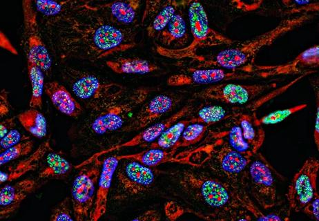 Fluorescent Imaging immunofluorescence of cancer cells growing in 2D with nuclei in blue, cytoplasm in red and DNA damage foci in green
