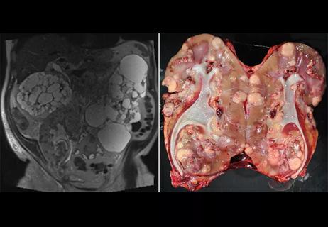 Donor-Derived Renal Cell Carcinoma in a Kidney Allograft: A Case