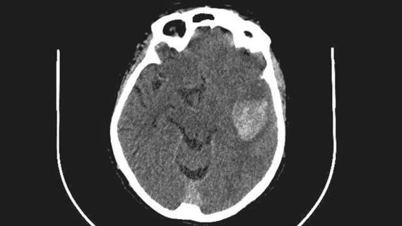 intracerebral hemorrhage on a brain scan