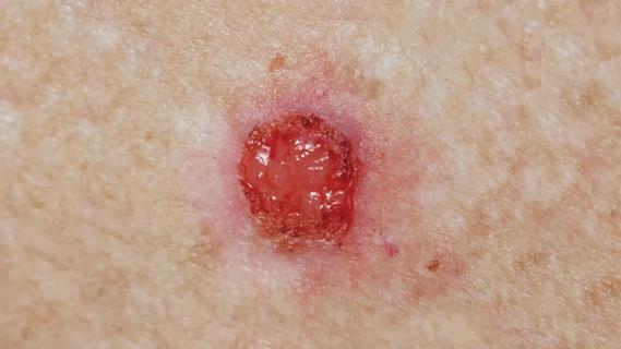 Basal cell carcinoma